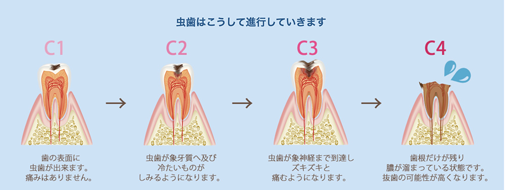 虫歯はこうして進行していきます